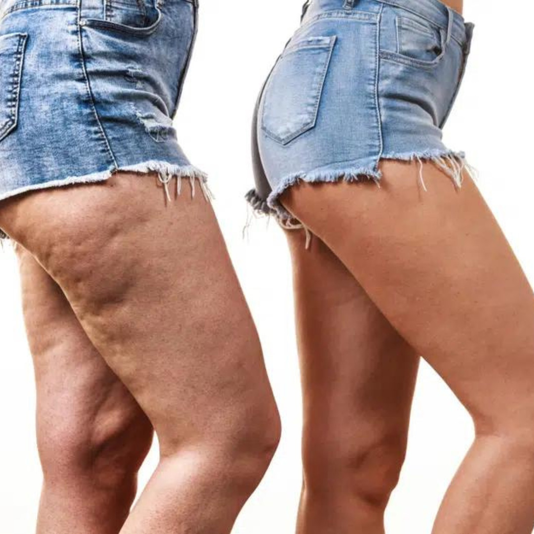 Cellulite Treatment